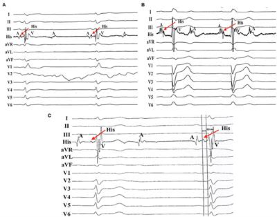 Feasibility and Safety of Permanent Left Bundle Branch Pacing in Patients With Conduction Disorders Following Prosthetic Cardiac Valves